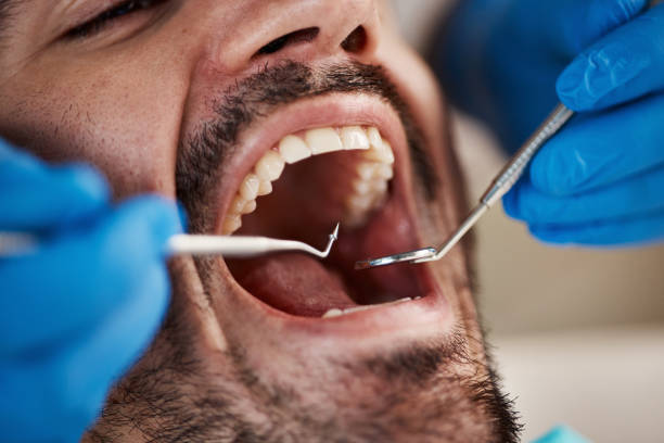 Best Emergency Dental Care for Broken or Chipped Teeth in San Antonio, TX